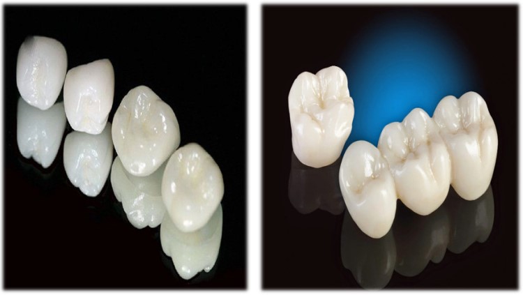 So sánh răng sứ Zirconia và Vita chi tiết nhất