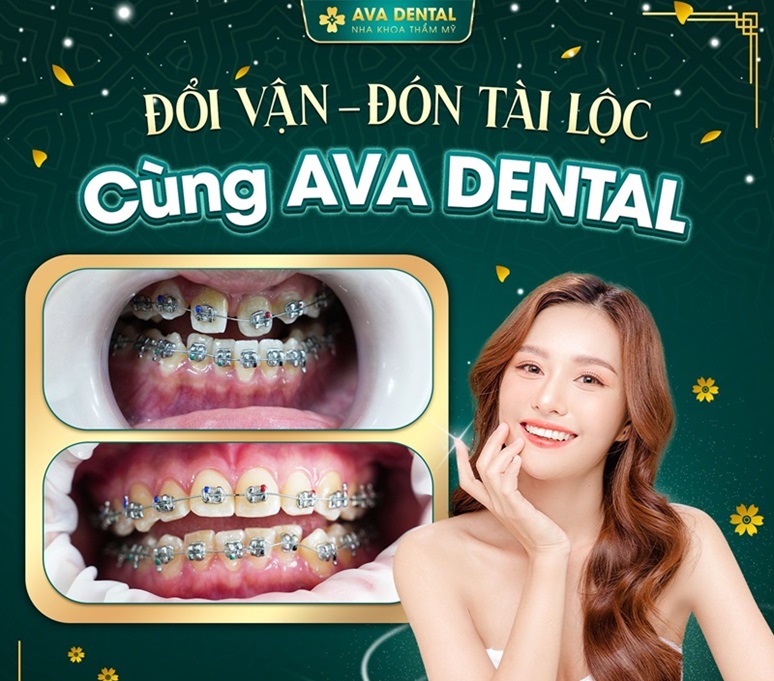 ava dental dia chi nieng rang tai tphcm uy tin nhat hien nay 4